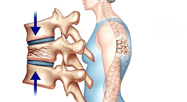 Vỡ lún cột sống làm cho cơ thể đau nhức