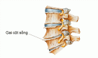 PHƯƠNG PHÁP ĐIỀU TRỊ GAI CỘT SỐNG