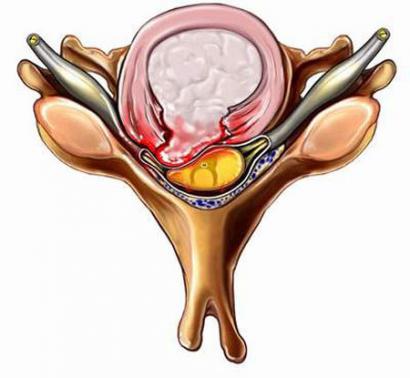 CHỮA BỆNH PHÌNH ĐĨA ĐỆM HIỆU QUẢ